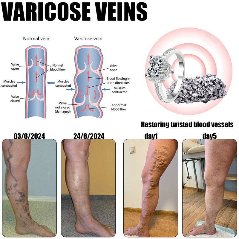 🔥✨🩵𝐋𝐚𝐬𝐭 𝐃𝐚𝐲 𝐃𝐢𝐬𝐜𝐨𝐮𝐧𝐭: 87% 𝐎𝐅𝐅🔥Histone™ Lymphatic Magnetic Therapy Heart Ring
