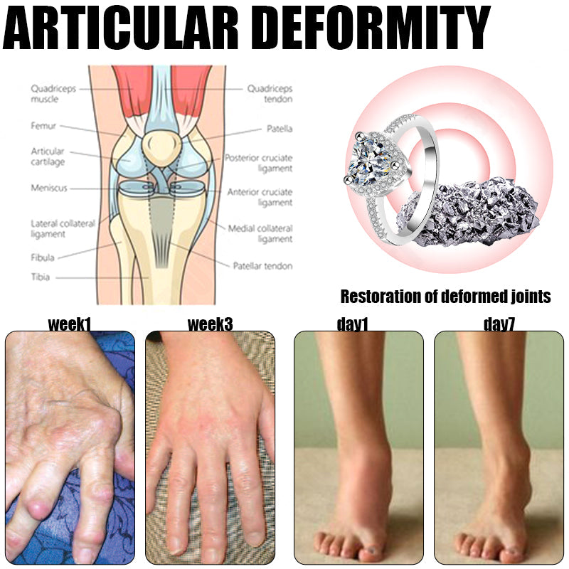 🔥✨🩵𝐋𝐚𝐬𝐭 𝐃𝐚𝐲 𝐃𝐢𝐬𝐜𝐨𝐮𝐧𝐭: 87% 𝐎𝐅𝐅🔥Histone™ Lymphatic Magnetic Therapy Heart Ring