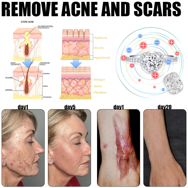 🔥✨🩵𝐋𝐚𝐬𝐭 𝐃𝐚𝐲 𝐃𝐢𝐬𝐜𝐨𝐮𝐧𝐭: 87% 𝐎𝐅𝐅🔥Histone™ Lymphatic Magnetic Therapy Heart Ring