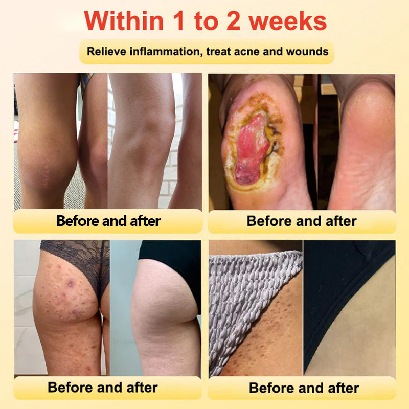 🔥✨🩵𝐋𝐚𝐬𝐭 𝐃𝐚𝐲 𝐃𝐢𝐬𝐜𝐨𝐮𝐧𝐭: 87% 𝐎𝐅𝐅🔥Histone™ Lymphatic Magnetic Therapy Heart Ring