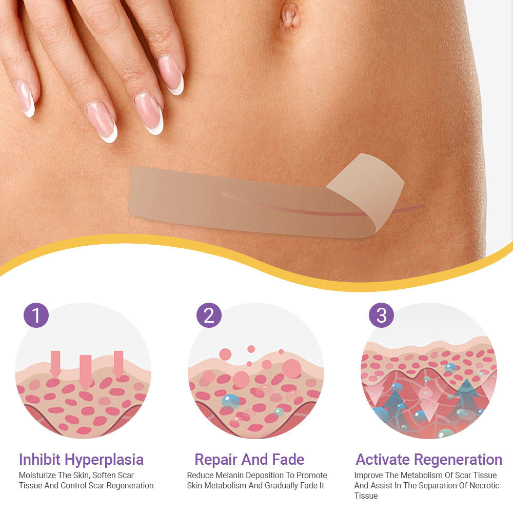 ✅Official Store | Oveallgo® Hyaluronic Acid Nano Microneedle Repair Tape🏥(Treatment of old and new scars, reduction of surgical scars, stretch marks, keloids, acne, burns, warts, dermatomes and varicose veins)