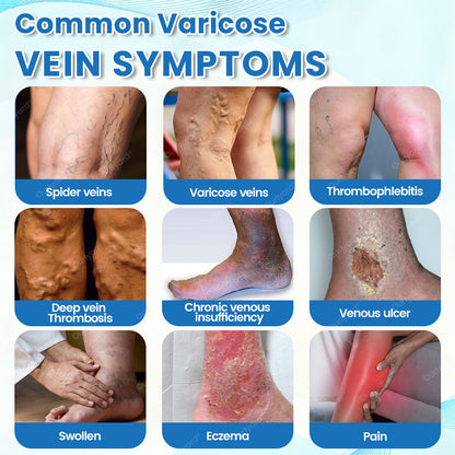 🇬🇧✅✅Ourlyard® VascuCare Vein Healing Spray(Designed for Varicose veins, Spider veins, Deep vein Thrombosis, Chronic venous insufficiency, Venous ulcers, Thrombophlebitis and other venous issues)
