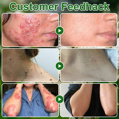 🔥Skavix™  Tea Tree Oil Skin Treatment Cream✅𝐅𝐃𝐀-𝐀𝐏𝐏𝐑𝐎𝐕𝐄𝐃 – Removes Skin Blemishes, Repairs Damaged Skin, Brightens & Anti-Ageing Care