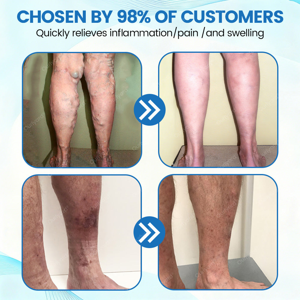 🇬🇧✅✅Ourlyard® VascuCare Vein Healing Spray(Designed for Varicose veins, Spider veins, Deep vein Thrombosis, Chronic venous insufficiency, Venous ulcers, Thrombophlebitis and other venous issues)