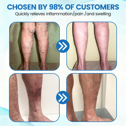 🇬🇧✅✅Ourlyard® VascuCare Vein Healing Spray(Designed for Varicose veins, Spider veins, Deep vein Thrombosis, Chronic venous insufficiency, Venous ulcers, Thrombophlebitis and other venous issues)