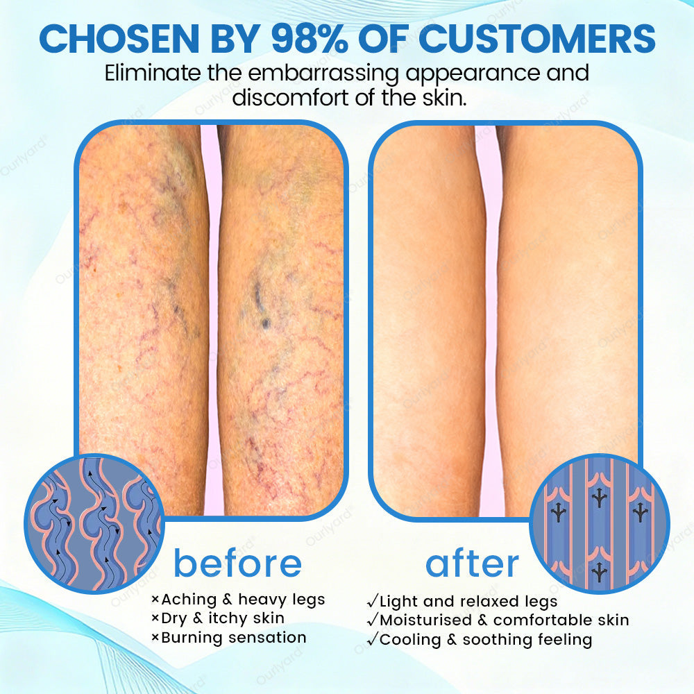 🇬🇧✅✅Ourlyard® VascuCare Vein Healing Spray(Designed for Varicose veins, Spider veins, Deep vein Thrombosis, Chronic venous insufficiency, Venous ulcers, Thrombophlebitis and other venous issues)