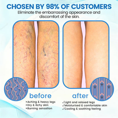 🇬🇧✅✅Ourlyard® VascuCare Vein Healing Spray(Designed for Varicose veins, Spider veins, Deep vein Thrombosis, Chronic venous insufficiency, Venous ulcers, Thrombophlebitis and other venous issues)